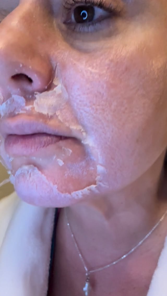 Set your skin up for Success!
THE PERFECT DERMA T™
PEEL
The ONLY Medium
Depth Medical Grade
Chemical Peel with
Glutathione For All Skin
Types • All Ethnicities •
Perfect Results in just 7 Days