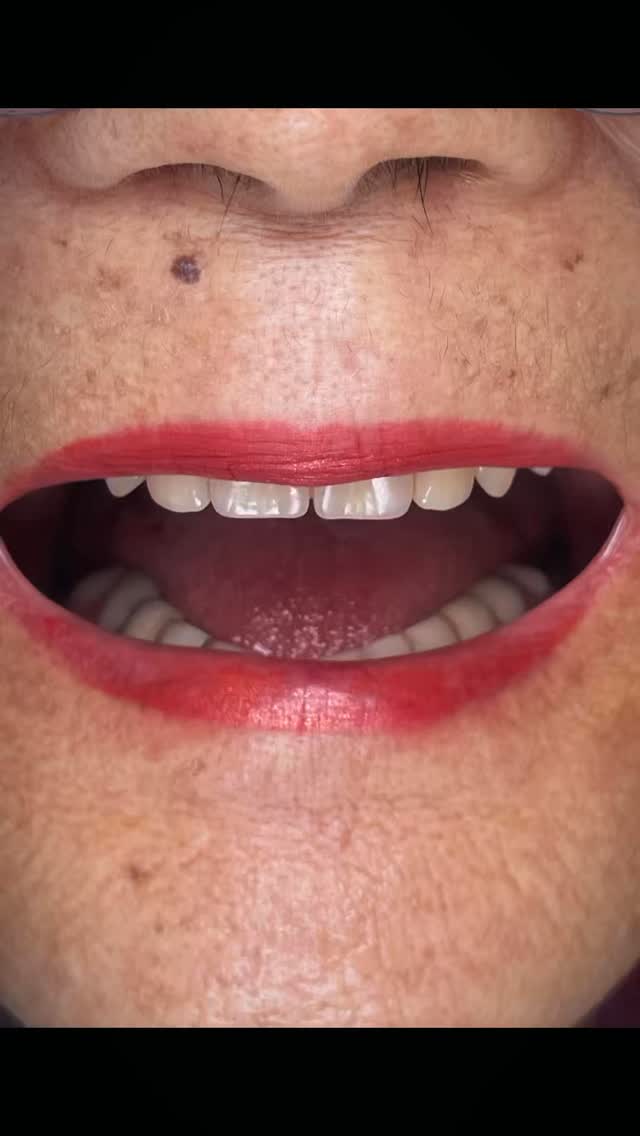 A Odontologia na arte de ser dentista, cuidar de dentes, ao qual nos formamos, ouvir o paciente e
compreender as suas necessidades. Se colocar no lugar do outro e saber utilizar as técnicas aprendidas e desenvolvidas ao longo do tempo para fazer do problema, a solução para este caso e para os próximos que virão. #saudebucal #protesesdentárias #implante #sorriso