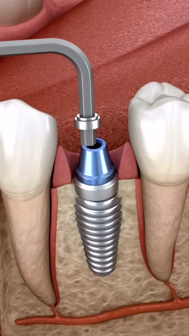 La colocación de un implante dental es un procedimiento seguro, preciso y con resultados duraderos.
En este caso, nuestro equipo realiza la cirugía guiada para asegurar la máxima exactitud y una recuperación rápida ☺️
👉 Cada detalle importa: planificación digital, materiales de calidad y un equipo especializado en implantología avanzada.
📍 En Clínica Tresserra cuidamos de tu sonrisa desde la raíz.
#ImplantesDentales #CirugíaOral #ClínicaTresserra #SaludDental #ImplantologíaAvanzada #SonrisasTresserra