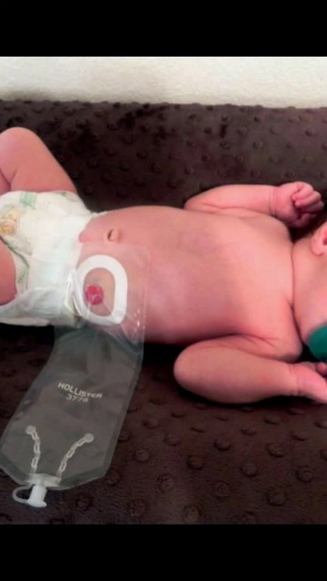 💚 Você sabe o que é ser ostomizado?
Muita gente ainda não faz ideia…
Esta imagem representa uma realidade vivida por milhares de pessoas — inclusive bebês — que passam por cirurgias e precisam de uma bolsa de ostomia para continuar vivendo com dignidade.
Queremos abrir o diálogo! 👇
❓Você tem dúvidas sobre a ostomia?
❓Sabe como é o dia a dia de um ostomizado?
❓Ou quer entender como apoiar quem vive essa condição?
Deixe sua pergunta nos comentários 💬
Vamos juntos quebrar o tabu, espalhar informação e empatia. 💚
#EuMeImporto #IBRAPPER #Ostomia #Conscientização #Inclusão #VidaComDignidade #pessoasostomizadasimportam