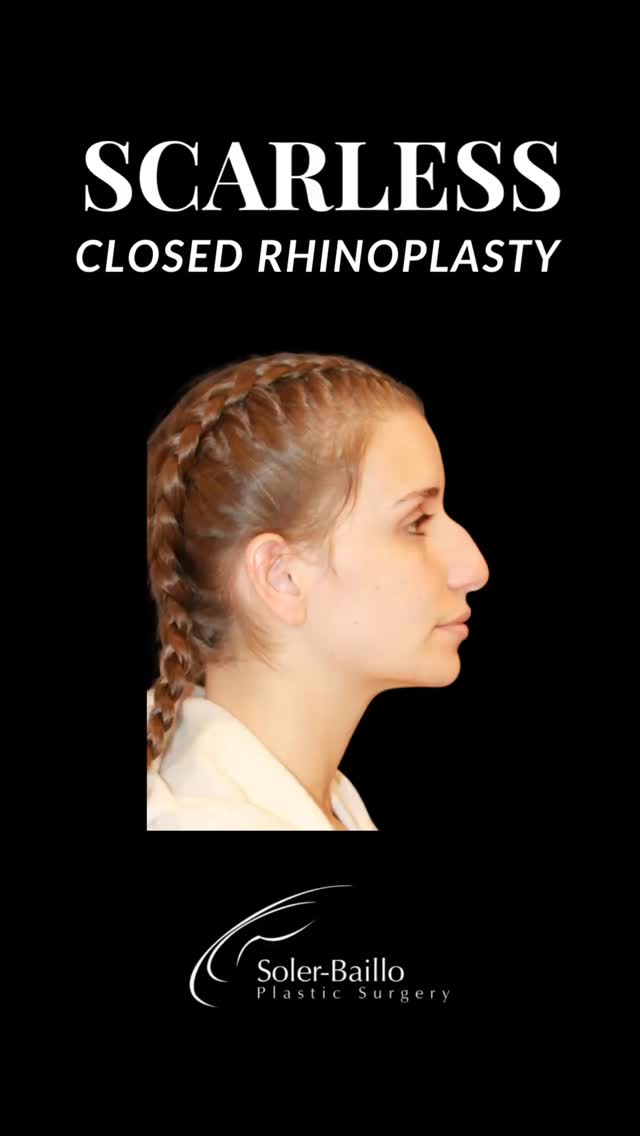 ⭐️No visible scars. Just refined, natural beauty.
Closed rhinoplasty enhances your features - quietly, confidently, beautifully. All incisions are made inside the nose, allowing for very natural contouring and faster recovery.❤️🩹
It’s not about changing your face - it’s about refining what already makes you beautiful.
💬Want to learn more?
📳 305-661-1996
📍Soler-Baillo Plastic Surgery
#closedrhinoplasty #drsolerbaillo #plasticsurgerymiami #rhinoplasty #rhinoplastybeforeandafter