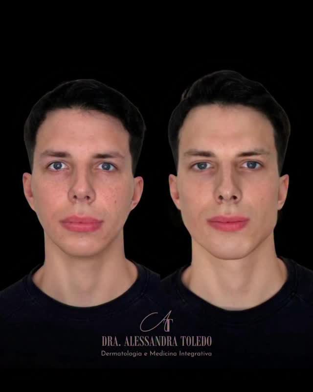 Homens também merecem um contorno facial marcante. 💪
Muitos têm a parte inferior do rosto naturalmente menos desenvolvida, o que pode deixar a face com aspecto mais fino ou juvenil demais.
Com o protocolo Face Up, conseguimos projetar, definir e equilibrar essa região, trazendo mais firmeza, estrutura e masculinidade, sem perder a naturalidade.
👉 O resultado? Um rosto mais harmônico, forte e com traços que valorizam sua essência.
#FaceUp #HarmonizaçãoFacialMasculina #DraAlessandraToledo #ResultadosNaturais #MasculinidadeElegante