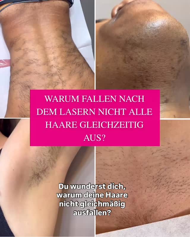 💭 Du wunderst dich, warum nach deiner Laserbehandlung nicht alle Haare gleichzeitig verschwinden?
Ganz normal – dein Körper arbeitet in Phasen! ✨
Unsere Haare befinden sich nie alle gleichzeitig in der gleichen Wachstumsphase. Nur die Haare in der aktiven Anagen-Phase können durch den Laser dauerhaft zerstört werden.
Das bedeutet: Einige fallen sofort nach 10-14 Tagen aus , andere erst Wochen später. Manche brauchen sogar die nächste Sitzung, um erfasst zu werden. 💫
Bei jeder Behandlung werden es weniger und feiner – bis deine Haut dauerhaft glatt ist. 🪷
📍Bei Tigerlily Waxing & Laser Berlin begleiten wir dich Schritt für Schritt auf dem Weg zu deiner smoothen Haut.
#Laserhaarentfernung #DauerhafteHaarentfernungBerlin #TigerlilyWaxing #LaserBerlin #HaarentfernungBerlin #SmoothSkinJourney #LaserTreatment #BeautyBerlin #WaxingStudioBerlin #HautpflegeBerlin #HairRemovalBerlin #TigerlilyLaser #GlatteHaut