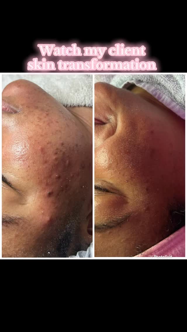 Are You FacingIT?!
✨ Facials | Waxing | Body Contouring | Yoni Steams | Sauna Blanket ✨
Come visit FacingIT in East Point, GA—your go-to destination for radiant skin, smooth results, and total body wellness. Whether you’re looking for a refreshing facial, expert waxing, advanced body contouring, or a relaxing yoni steam and sauna blanket session, FacingIT has you covered!
🌐 Book your appointment now at www.aubriafacingit.com
📍 Located in East Point, GA
We offer a variety of personalized services including:
💆♀️ Customized Facials
🧖♀️ Yoni Steams
🔥 Sauna Blanket Detox
🧴 Body Contouring & Wax Combos
🎁 Monthly Specials & Deals
Ready to glow? Click the link, book your service, and don’t forget to refer a friend while you’re there!
#Atlanta #AtlantaLife #AtlantaFood #AtlantaEats #AtlantaNights #AtlantaStyle #AtlantaArt #AtlantaPhotos #AtlantaPhotography #AtlantaStreets #AtlantaTimes #AtlantaLiving #AtlantaLifestyle #AtlantaMoments #AtlantaLove #PeopleOfAtlanta #AtlantaFashion #AtlantaMusic #AtlantaNightlife #AtlantaDaily #AtlantaFitness #AtlantaFit #AtlantaInfluencer
#AtlantaBlog #AtlantaShopping #AtlantaRestaurants #AtlantaFoodie #AtlantaAdventures #AtlantaVibes #AtlantaHomes