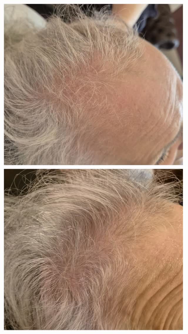 ✨ Only 4 of 6 PRP sessions completed — and the regrowth is already visible! ✨
This client is halfway through their recommended PRP hair restoration course, and you can already see thicker, healthier hair starting to come through. 💪
PRP (Platelet-Rich Plasma) works by using your body’s own healing power. A small sample of your blood is processed to extract plasma rich in growth factors, which is then injected into the scalp. These growth factors stimulate dormant follicles, improve circulation, and strengthen existing hair — naturally.
💡 Why a full course matters:
Hair growth is a gradual process. Each session builds on the last, reawakening follicles and improving scalp health over time. Most clients start noticing new baby hairs from session 3 onwards, with full results visible after completing the full 6 sessions.
✨ Results you can expect:
Thicker, denser hair
Reduced shedding
Stronger, healthier follicles
Natural, long-lasting improvement
This client’s progress after just 4 sessions shows what’s possible when you commit to a full PRP course — and the best is yet to come. 💫
Book your consultation today and begin your journey towards stronger, fuller hair.