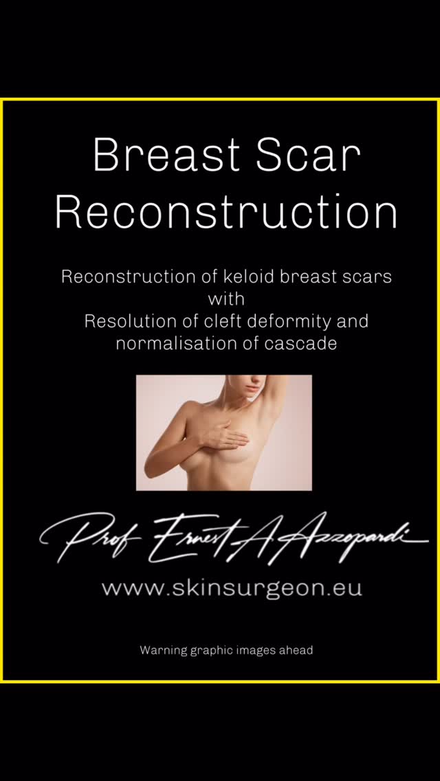 🌸 Pink October | Restoring Confidence, Restoring You 🌸
Every scar tells a story — but it need not define the ending.
Our advanced laser and scar refinement treatments help restore softness, symmetry, and confidence after breast surgery or trauma.
Because healing is not just about the body — it’s about how you feel when you see yourself again.
✨ Expertly performed by Professor Ernest Azzopardi – Plastic, Reconstructive & Laser Surgeon
📍 www.skinsurgeon.eu
#PinkOctober #BreastScarTreatment #BreastCancerAwareness #LaserScarRevision #ScarRefinement #ConfidenceRestored #AestheticHealing #SkinSurgeonEU #ProfessorErnestAzzopardi #PlasticSurgeryMalta #LaserExcellence #HealingBeyondScars