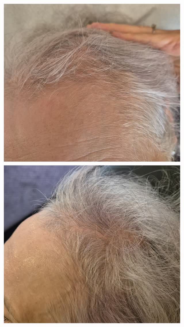 ✨ Struggling with thinning hair or hair shedding? You’re not alone — and you don’t have to just accept it.
PRP (Platelet-Rich Plasma) is one of the most effective natural solutions for restoring thicker, healthier hair. Using your own blood’s growth factors, PRP works to awaken dormant follicles, stimulate new growth, and strengthen existing hair from the root — safely and naturally.
💛 No toxins.
💛 No artificial products.
💛 Just your own body, healing itself.
Most clients start to notice baby hairs and fuller texture within a few sessions — and the confidence that comes with seeing real regrowth is priceless.
If your ponytail feels thinner, your parting is widening, or you’re simply not feeling like yourself lately, this could be the treatment that changes everything.
✨ Natural. Proven. Powerful.
PRP is the gold standard for hair restoration — and your journey can start today.
📅 Book your consultation and let’s bring your hair back to life.