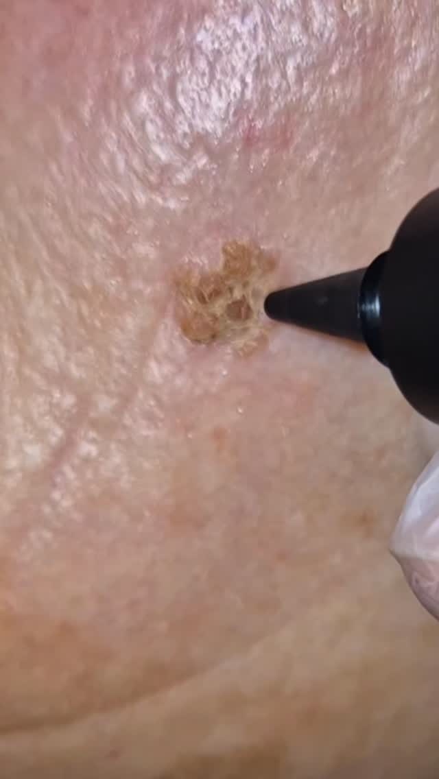 ✨ Seborrhoeic Keratosis Removal with Cryotherapy ✨
Seborrhoeic keratoses are common, harmless skin growths that tend to appear with age. They can range in colour from light brown to almost black, and often have a raised, rough, or waxy appearance. While completely benign, many people choose to have them removed for cosmetic reasons or because they become irritated or uncomfortable.
At our clinic, we use cryotherapy — a safe and effective method that involves applying a precise burst of cold to the lesion. This freezes and destroys the unwanted skin cells, allowing new, healthy skin to form naturally underneath.
💡 Benefits of cryotherapy:
Quick and minimally invasive
Safe and precise treatment
Minimal downtime
Suitable for all skin types
Over the following days, the treated area will darken and naturally shed, revealing smoother, clearer skin beneath.
If you have raised, rough, or pigmented patches you’d like assessed, book a consultation to find out whether cryotherapy is right for you.
