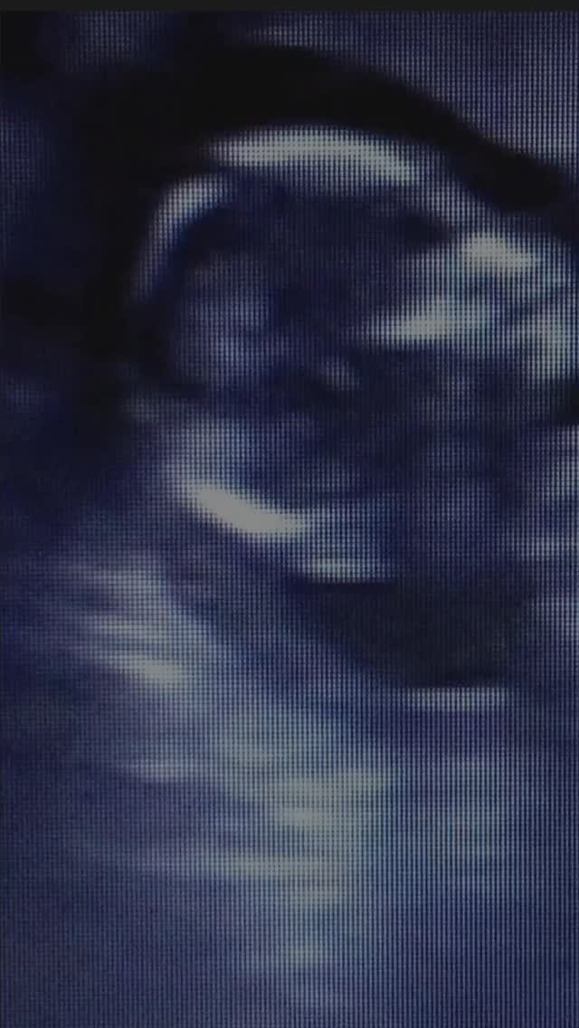 🎥 What, Why & When of the NT Scan 🤰💫
The NT (Nuchal Translucency) Scan is one of the most important early pregnancy screenings — but do you really know why it’s done and when it should be scheduled?
🩺 What: It measures the fluid behind your baby’s neck using ultrasound.
💡 Why: Helps assess the risk of chromosomal conditions like Down syndrome and checks your baby’s early development.
🗓️ When: Between 11 to 14 weeks of pregnancy — the ideal window for accurate results.
It’s quick, safe, and gives crucial insights for you and your doctor early on.
Because when it comes to your baby’s health — knowledge is care. 💖
#fyp #trending #ntscan #drnamitakapoorsahgal #gynaecologist #manipalhospital #obstetrician #bengaluru #womenhealth #trending #pregnancy