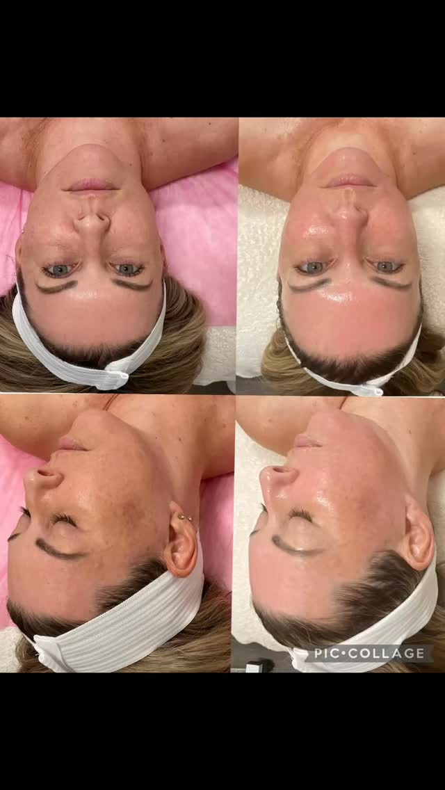 #capricebeautybar #age #sarasotaflorida #sarasota #skin #medspa #hifu #microneedeling #sarasotawedding #sarasotahair #sarasotamedspa #sarasotahifu #sarasotafacepeels #sarasotaweddingphotographer #sarasotabeautywellness