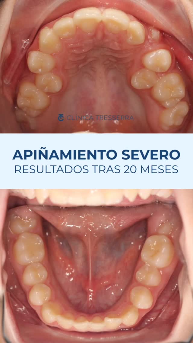 ✨ Transformaciones que hablan por sí solas.
Nuestro paciente de 15 años llegó con un apiñamiento severo, la línea media desviada y dos premolares que habían erupcionado por el paladar 😬
Tras un tratamiento planificado con precisión —incluyendo la extracción de los premolares ectópicos y el centrado de la línea media—, el cambio es simplemente impresionante.
🦷 20 meses después… una sonrisa alineada, funcional y llena de confianza.
Porque los grandes resultados llevan tiempo, constancia y un buen equipo detrás 💙
#Ortodoncia #AntesYDespués #ClínicaTresserra #OrtodonciaInvisible #SonrisasTresserra #ortodonciabarcelona
