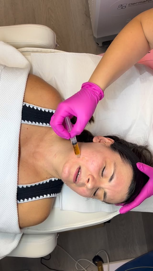 The treatment every celebrity get done! Radio frequency Microneedling. My clients love this treatment as it helps to lift, firm and smooth the skin and results can be seen after the first session. #dermaforce #aestheticsbyam #oxford #oxfordsalon #oxfordaestheticclinic #oxforduniversity #oxfordshire #oxfordbeauty