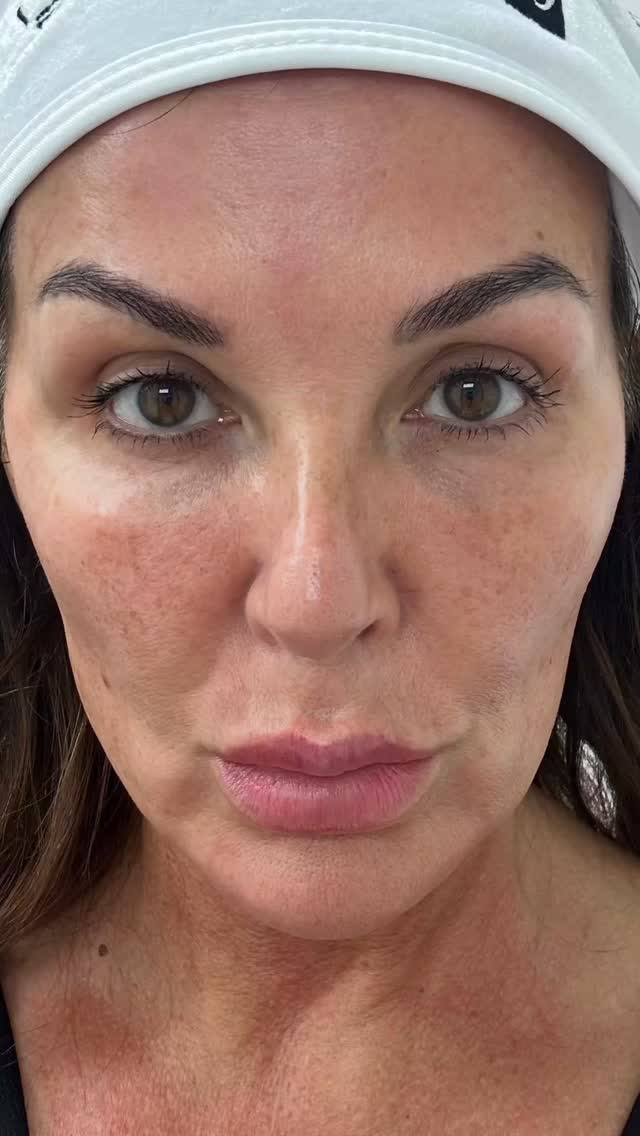 #skincareroutine #microneedlingtherapy @tjpa.co.uk