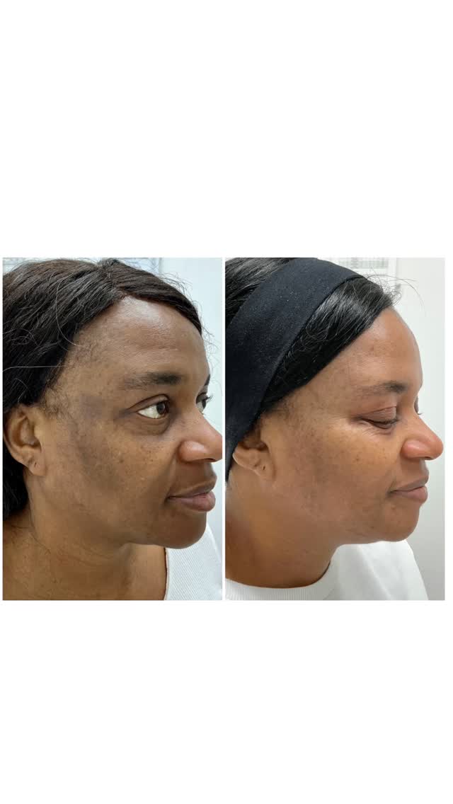 Hyperpigmentation is our favouriting to treat.
I personally love the transformation on the skin but also the smiles it creates through confidence.
Our lovely client came to us with concerns of uneven skin tone.
After a thorough consultation and a professional skin scan, we could see her pigmentation was dermal (meaning deep) so we recommended the appropriate medial peel for the best results.
Skin was prepared for 3 weeks before treatment. When the skin is in the best state the treatment will be carried deeper into the skin and work rapidly to pull the pigment out.
After care was prescribed to continue giving our client fast skin cell turn over resulting in a lighter brighter even skin tone.
If you would like professional help with your skin concerns, get in contact with us today.
@theksclinic #theksclinic #hyperpigmentation #pigment #pigmentation #darkmarks #darkmarksremoval #darkspots #evenskintone #glassskin #clearskinjourney #beforeandafter #oldbury #sandwell #birmingham #wallsall #wolverhampton #harborne #manchester #skinclinic #hyperpigmentationtreatment
