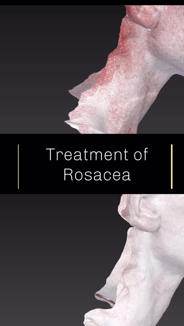 ✨ Calm Confidence for Rosacea ✨
A 3D scan reveals how our exclusive, laser protocol reduces the redness and tiny vessels of rosacea — skin appears calmer, clearer, and more even.
But true results come from expertise, not just technology.
It takes a surgeon’s precision to tailor each pulse for safe, natural improvement.
💡 Good tools help — expert hands make the difference. Exclusively at Skinsurgeon by Prof Ernst Azzopardi London and Malta
📩 info@skinsurgeon.eu
🌐 www.skinsurgeon.eu
#RosaceaTreatment #RosaceaRelief #LumenisM22 #LaserDermatology #SkinSurgeonEU #AestheticMedicine #LaserScience #PrecisionAesthetics #SkinConfidence #surfaceimagingsolutions