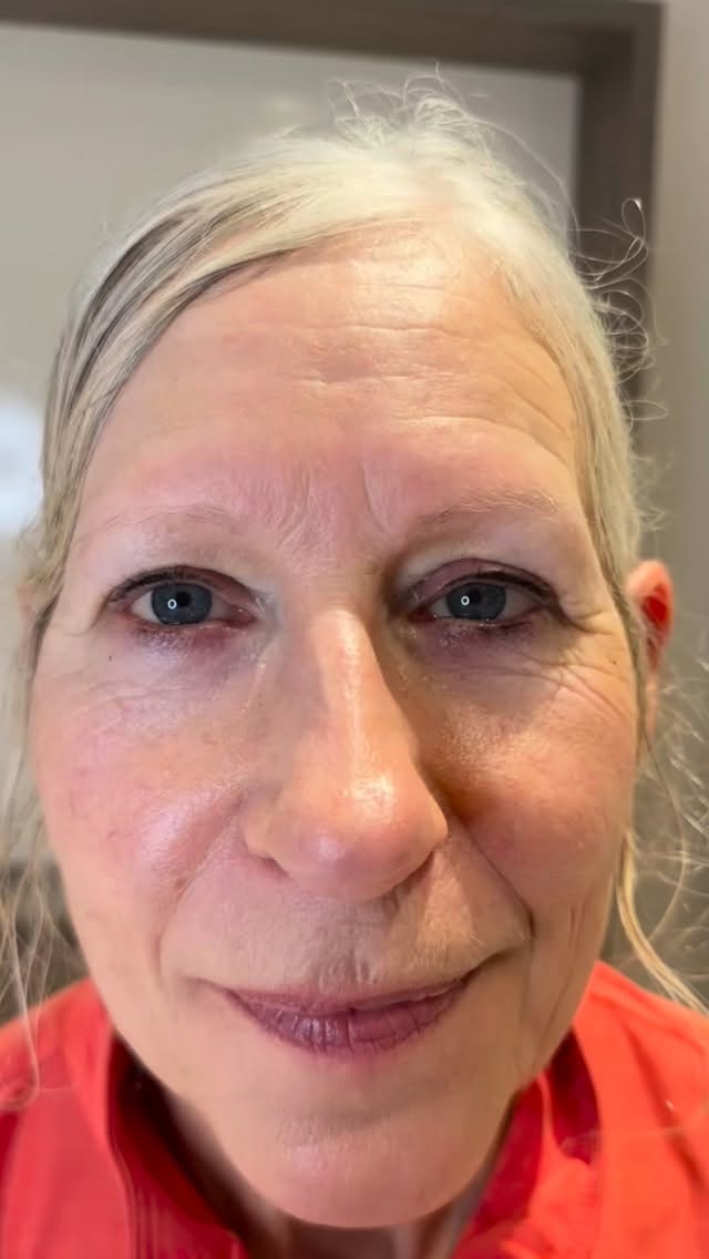 The most beautiful brow transformation for our gorgeous client.
From no brows to the most gorgeous shape and size that perfectly suit her face. Colour will fade by 30-40% to the most perfect ashy brown!
#spmubrows❤️ #huntly #aberdeenshire #aberdeen #skinclinic #banff #insch #aestheticpractitioner #spmu #browtransformation #combobrow #ombrebrow #microblading #combinationbrows