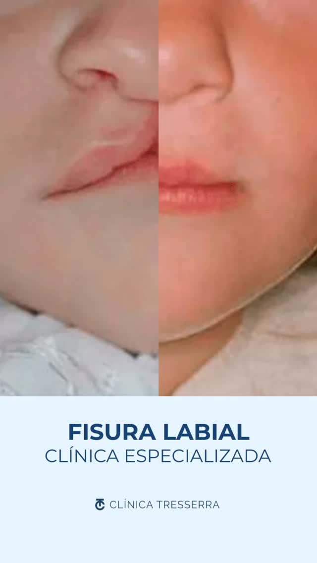 🩵 Más que una cirugía, una transformación de vida.
Nuestro equipo especializado en fisura labial y palatina acompaña a cada paciente desde el primer diagnóstico hasta la recuperación final, con un enfoque médico, estético y humano.
Cada caso es único, cada sonrisa… irrepetible.
Porque detrás de cada “antes y después” hay una historia de superación, confianza y esperanza.
✨ En Clínica Tresserra, reconstruimos mucho más que sonrisas.
#FisuraLabial #CirugíaMaxilofacial #ClínicaTresserra #SonrisasQueInspiran #CirugíaOral #DentistaBarcelona