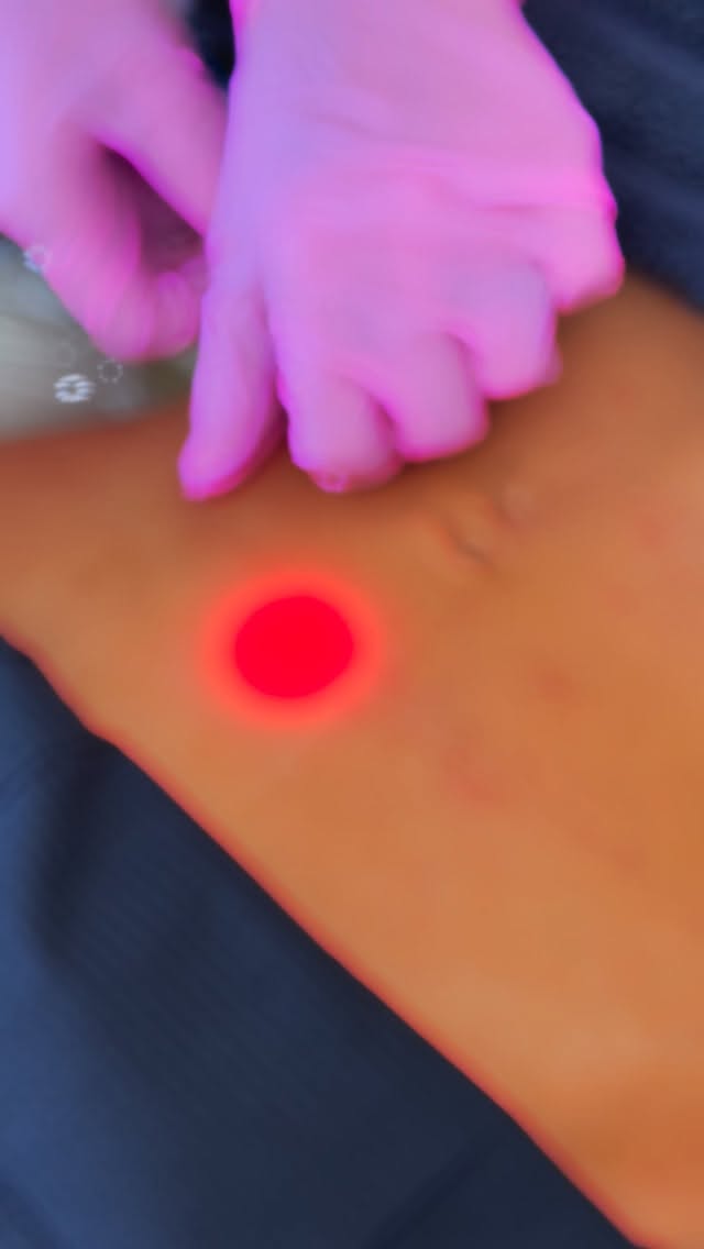 The lower belly is where the body loves to store fat (even when you’re eating well, moving your body, and doing all the “right” things). 😭
Hormones, stress, genetics — they all play a part.
So if that area feels stubborn, it’s not just you.
EndoFuze targets that exact fat layer.
It works by delivering controlled heat below the skin to melt and disrupt fat cells, then encourages your body to flush them out naturally… while also tightening the skin as it heals.
So you’re not just losing volume.
You’re getting smoother, tighter, flatter shape.
Heat. Melt. Tighten. Smooth.
Real changes.
No gym trauma. No endless crunches. No crying over jeans 😇
And because it’s the season of looking snatched under a sequin dress…
50% OFF EndoFuze until Christmas 🎄
(Yes, really.)
If your lower belly has been on your mind every time you get dressed… take the sign.
DM FUZED to secure your slot 🔥
#endolift #endoliftlaser #endolaser #endofuze #derbyaesthetics #aestheticsderby #lipfillerderby #lipfillernottingham #aestheticsnottingham #aestheticsleicester #aestheticsbirmingham #lipfillernottingham