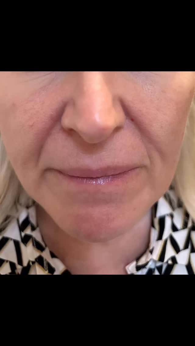 @tjpa.co.uk #maidstone #skintagremoval #microneedlingtherapy #sevenoaksmums #ditton #aylesford #sevenoaks