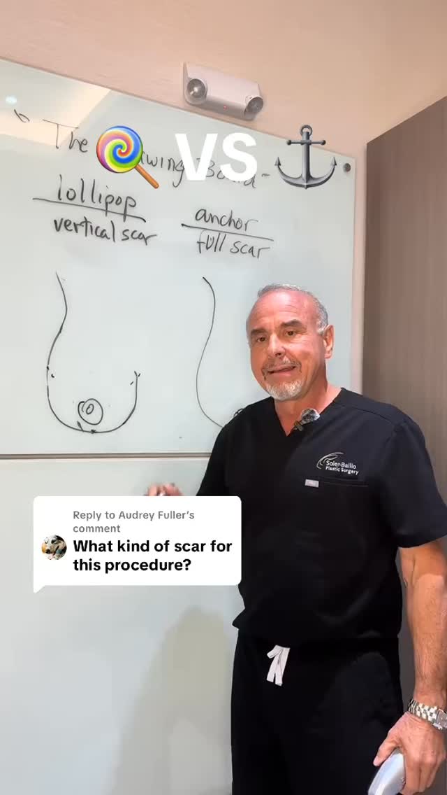 🍭Lollipop or Anchor?⚓️
Dr. Soler-Baillo breaks down the difference between these two breast lift techniques on the drawing board. Learn how incision placement and scar shape are customized to your anatomy and aesthetic goals. 🎥✨
#breastlift #Mastopexy #MiamiPlasticSurgery #BreastLiftScars #PlasticSurgeryEducation