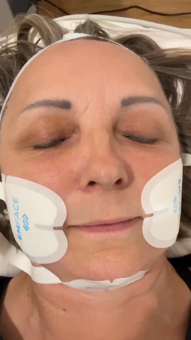 Emface days are the most fun days in the clinic.
We love seeing those elevator muscles getting strong to lift everything where we want it!
💛
#emfacedays @btlaesthetics
#OgeeFacialRejuvenation
#NonSurgicaltreatments #Emface #emfacetreatment #facialrejuvenation#noninvasivetreatment #noninvasivefacelift #collagenboost #canberraskinclinic #cosmetictreatments #antiaging