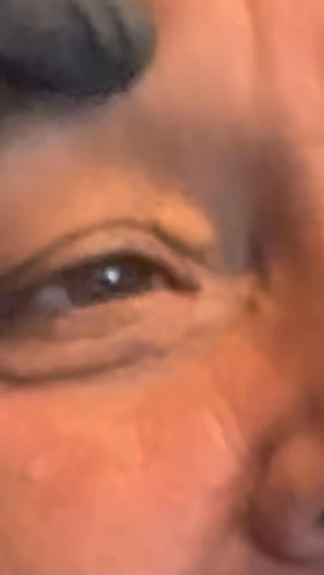 ✨ ¿Notaste pequeñas placas amarillentas en los párpados o alrededor de los ojos?
Podrían ser xantelasmas, depósitos de grasa benignos pero visibles que, si bien no duelen, suelen generar preocupación estética.
💡 Más allá de la apariencia, los xantelasmas pueden ser una señal de colesterol o triglicéridos elevados, por lo que siempre recomendamos una evaluación médica integral.
🔬 En nuestro consultorio los tratamos con Láser de CO₂, una técnica precisa, segura y con excelente resultado estético, que permite eliminarlos con mínima molestia y rápida recuperación.
📲 Si te molestan y querés tratarlos, agendá tu turno al 11 6666-2866 o enviá un mensaje directo.
#Xantelasmas #CuidadoDeLaPiel #SaludOcular #Dermatología #Bienestar #Plexr #LáserCO2 #Blefaroplastia #PlasmaLáser #XantelasmaEliminacion #Mujer #Hombre #DermatologiaEstetica #DraBuonsante