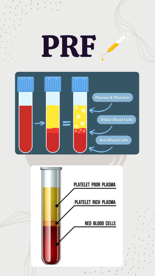PRF
자신의 혈소판과 성장인자를 이용해 피부를 회복·재생하는 PRF!
✔ 주요 효과
피부 속 콜라겐 생성 촉진 → 탄력 & 주름 개선
수분 & 영양 공급 → 촉촉한 피부
피부톤·결 개선 → 밝고 매끄럽게
상처 회복, 모공 축소, 잔흉터 완화에도 도움
PRF (Platelet-Rich Fibrin) uses your own platelets and growth factors to rejuvenate the skin naturally.
✔ Key Benefits
-Stimulates collagen production → improves elasticity & reduces wrinkles
-Provides hydration & nutrients → plump, healthy skin
-Improves skin tone & texture → brighter, smoother skin
-Supports healing, reduces scars, and tightens pores
#PRF #PlateletRichFibrin #SkinRejuvenation #SkinBoost #CollagenBoost #AntiAging #WrinkleTreatment #SkinCare #GlowSkin #HydratedSkin #YouthfulSkin #FacialRejuvenation #HealthySkin #SkinTreatment