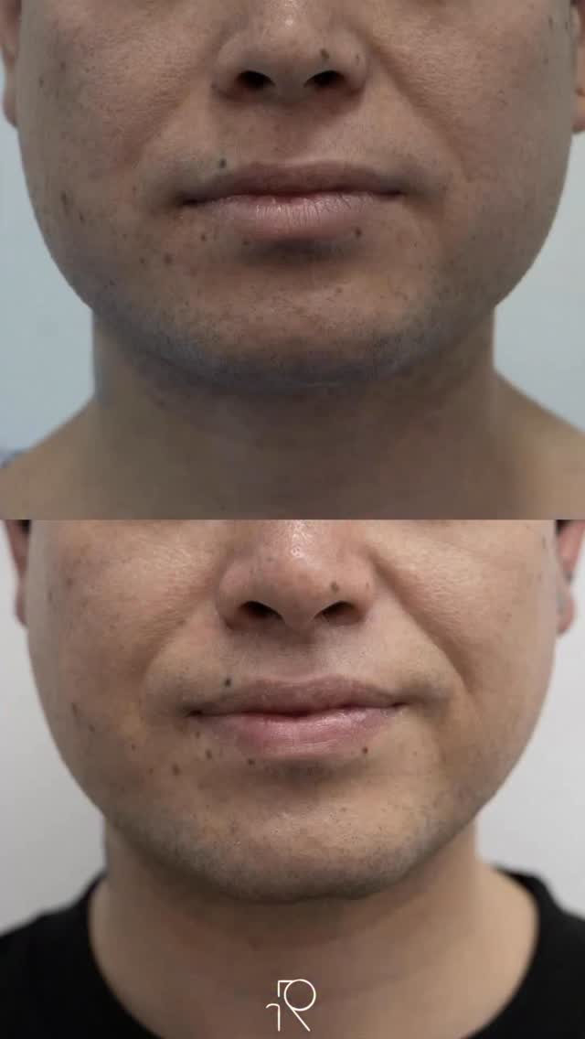 Pequeños cambios, grandes resultados ✨
Un upper lip lift que logra un equilibrio natural, manteniendo la expresión y la esencia masculina del rostro.