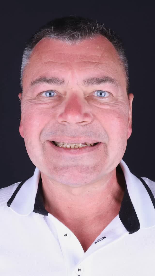 Для Владислава Масинскина путь к новой улыбке завершён!
Эстетическая реставрация верхних зубов выполнена с использованием передовых технологий и под контролем опытных специалистов.
Лечение нижней челюсти также успешно завершено — теперь у Владислава совершенно новая, сияющая улыбка!
Весь процесс прошёл надёжно и с вниманием к каждой детали.
📍 Sirius Dental Clinic — здесь начинаются новые улыбки.