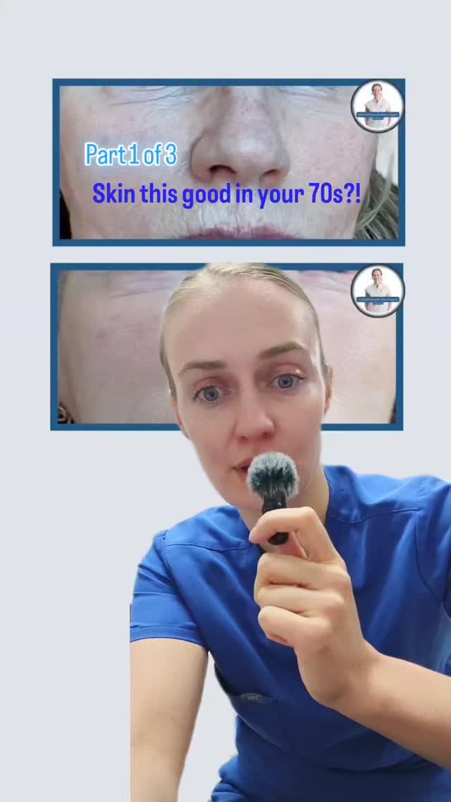 Results that speak for themselves part 1 of 3
(Stay tuned to see the rest of the face & neck!!)
SKIN!! it's all about skin. Love on it, work on it, get results like this.
P.s. the older we get, the more difficult it is to trick your skin into making more good shit like collagen and elastin.
So whatever decade you're in, it's not too late to start.
Results are real and totally possible.
The treatments:
6 Skinpen Microneedling
3 Profhilo
At home retinol/SPF
If you're ready to commit to yourself, I'm here. 💙
Megan x
Dentist led aesthetics & skincare in Glasgow
#skin #glowup #healthyskinforall