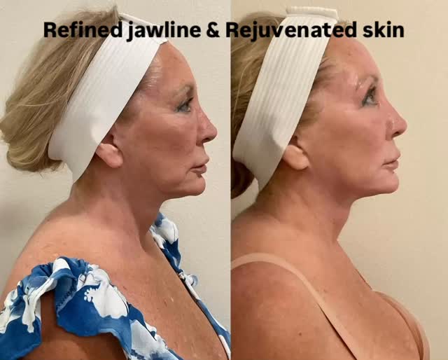 One advanced skin-resurfacing treatment can:
Define the jawline
Smooth texture
Reduce sun damage
Boost overall glow
Results you can see and feel.
#capricebeautybar #age #sarasotaflorida #sarasota #hifu #medspa #sarasotawomanowned #sarasotahifu #sarasotamedspas #sarasotafacialspecialist #sarasotaskin