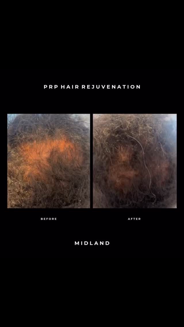 ✨ Real-Life PRP Hair Journey: Just 2 Sessions In! ✨
This lovely client is back for his third PRP session after having 2 sessions spaced 8 weeks apart due to work commitments. Typically, we recommend 3 sessions, 4–6 weeks apart for optimal results, but even with this adjusted schedule, the early progress is impressive!
💫 What we’re seeing so far:
• The scalp looks noticeably fuller
• The client has experienced a reduction in hair loss
• Overall scalp health is improving
This is a perfect example of how every PRP journey is unique. While hair growth is always the goal, reducing hair loss and improving scalp health are just as important — and realistic expectations are key.
Even if thickness isn’t fully restored yet, we can achieve a visibly fuller-looking scalp, which in this case is exactly what we’re aiming for. 🌿
𝖡𝗈𝗈𝗄𝗂𝗇𝗀𝗌
☏ 𝟢𝟩𝟦𝟫𝟪𝟫𝟪𝟩𝟣𝟪𝟪
☞︎ 𝗆𝗂𝖽𝗅𝖺𝗇𝖽𝖼𝗅𝗂𝗇𝗂𝖼𝗌@𝗀𝗆𝖺𝗂𝗅.𝖼𝗈𝗆
✩ 𝗐𝗐𝗐.𝗆𝗂𝖽𝗅𝖺𝗇𝖽𝖼𝗅𝗂𝗇𝗂𝖼.𝖼𝗈.𝗎𝗄
𝖬𝗂𝖽𝗅𝖺𝗇𝖽 𝖠𝖾𝗌𝗍𝗁𝖾𝗍𝗂𝖼𝗌 𝖢𝗅𝗂𝗇𝗂𝖼 𝖢𝗈𝗏𝖾𝗇𝗍𝗍𝗒
✩ 𝖬𝖾𝖽𝗂𝖼𝖺𝗅 𝖯𝗋𝖺𝖼𝗍𝗂𝗍𝗂𝗈𝗇𝖾𝗋 𝖫𝖾𝖽 𝖠𝖾𝗌𝗍𝗁𝖾𝗍𝗂𝖼𝗌
✩ 𝖥𝗎𝗅𝗅𝗒 𝖨𝗇𝗌𝗎𝗋𝖾𝖽 𝖢𝗈𝗌𝗆𝖾𝗍𝗂𝖼 𝖢𝗅𝗂𝗇𝗂𝖼
✩ 𝖯𝗋𝗂𝗏𝖺𝗍𝖾 𝖺𝗇𝖽 𝖢𝗈𝗇𝖿𝗂𝖽𝖾𝗇𝗍𝗂𝖺𝗅
#PRPHair #HairRegrowth #HairRestoration #HairLossSolution #PRPTherapy #ScalpHealth #PlateletRichPlasma #HairGrowthJourney #HairConfidence #NonSurgicalTreatment #AestheticClinic #HealthyHair #PRPSessions #HairThinningSolution #RegenerativeTreatment #HairRevitalisation