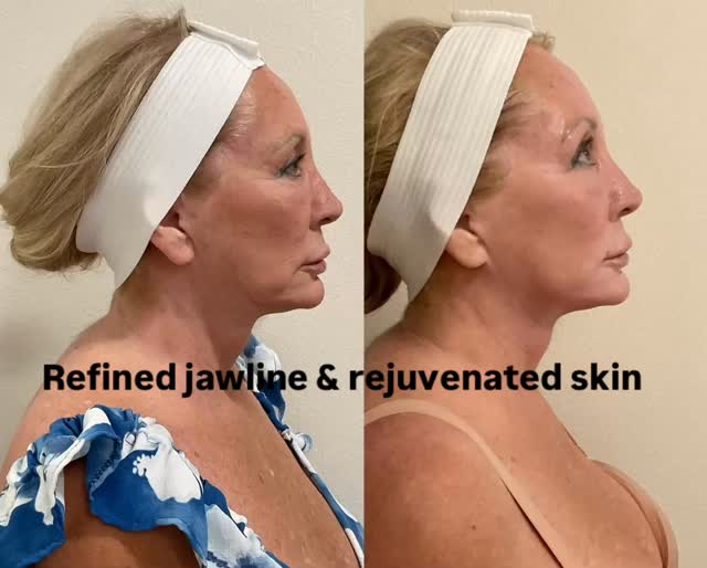 One advanced skin-resurfacing treatment can:
Define the jawline
Smooth texture
Reduce sun damage
Boost overall glow
Results you can see and feel.#capricebeautybar #age #sarasotaflorida #sarasota #hifu #medspa #sarasotawomanownedbusiness #sarasotahifu #sarasotafacelift #sarasotapeels
#sarasotamedspa