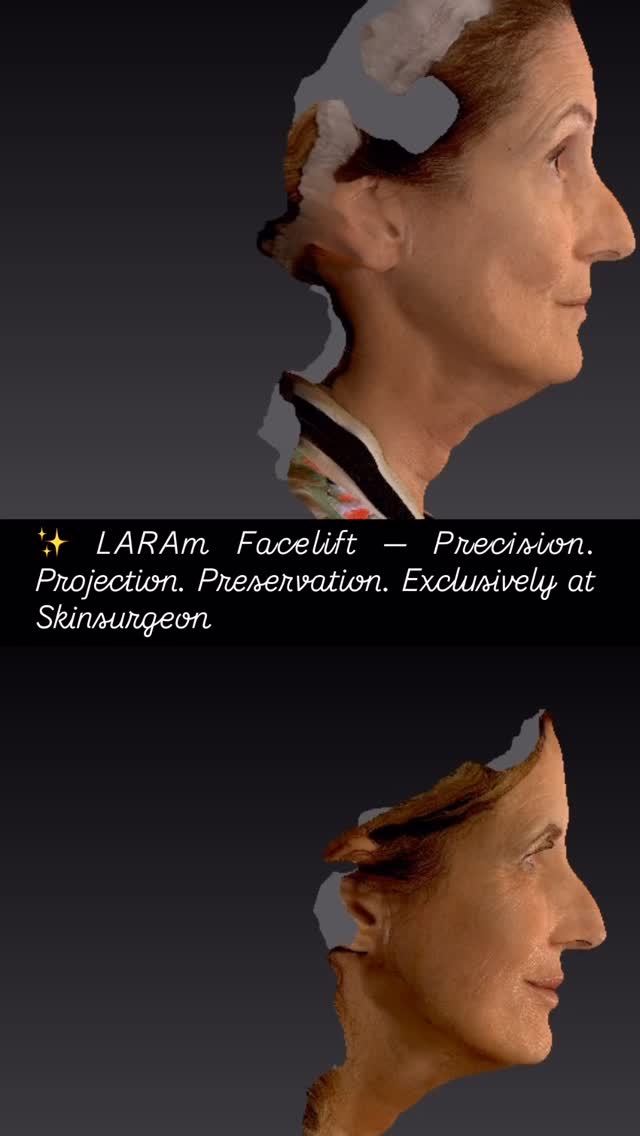 ✨ LARAm Facelift, revealed in 3D.
This synchronised scan highlights elegant neck–jawline definition and restored facial harmony — the hallmark of the LARAm approach.
Natural. Precise. Enduring.# ##
For bespoke facial rejuvenation:
📍 skinsurgeon.eu.
#LARAmFacelift #FacialRejuvenation #NeckLift #JawlineRestoration #AestheticSurgery #FacialAesthetics #LaserFacelift #AdvancedAesthetics #3DFacialImaging #ProfileRestoration #NaturalResults #PrecisionAesthetics #ConsultantPlasticSurgeon #LuxuryAesthetics #EuropeanAesthetics #SkincareInnovation #MaltaAesthetics #skinsurgeoneu
Thank you to our lovely patient for permissions