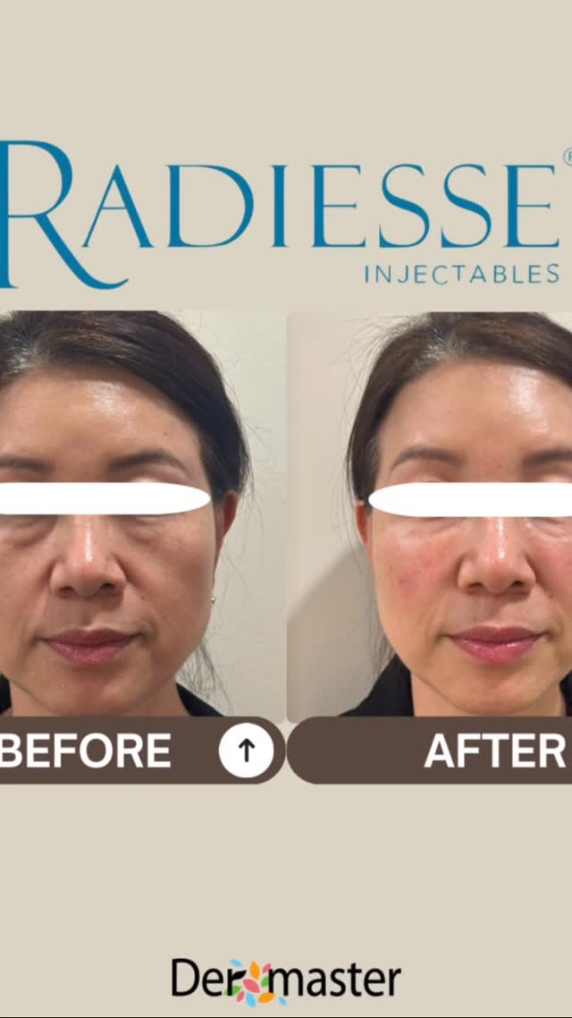 Radiesse 🪞
볼륨↑ 탄력↑ 자연 리프팅까지✨ 레디어스로 동안 얼굴 만들기
Volume↑ Elasticity↑ Natural lift✨ Achieve youthful contours with Radiesse
#Radiesse #FacialFiller #VolumeRestoration #CollagenBoost #YouthfulSkin #AntiAging #WrinkleTreatment #SkinLift #FacialRejuvenation #SkinCare