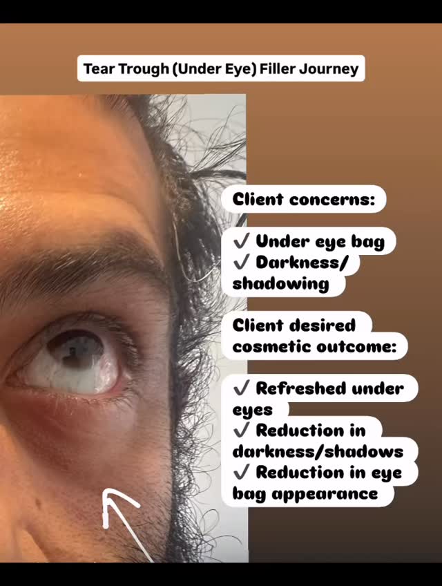✨ Under Eye Filler Transformation: A Real-Life Treatment Journey ✨
Every under eye filler treatment begins with a thorough assessment. In this case, we observed:
• Perforation in the orbital area
• Prominent eye bags
• Dark shadowing with a strong line appearance
• Loss of volume in the malar region
✅ It’s essential to evaluate skin quality before treatment—looking for good elasticity, smooth texture, and overall skin health—to ensure safe and effective results.
Next, we map out the treatment plan. Here, we targeted the malar region to help mask the perforated eye fat and eye bags, restoring support and smoothing the under eye area.
💉 The result: a refreshed, rejuvenated under eye area with:
• Reduced eye bags
• Diminished dark shadows
• Improved volume and overall youthful contour
A subtle yet transformative improvement that highlights the power of personalized treatment planning! ✨
𝖡𝗈𝗈𝗄𝗂𝗇𝗀𝗌
☏ 𝟢𝟩𝟦𝟫𝟪𝟫𝟪𝟩𝟣𝟪𝟪
☞︎ 𝗆𝗂𝖽𝗅𝖺𝗇𝖽𝖼𝗅𝗂𝗇𝗂𝖼𝗌@𝗀𝗆𝖺𝗂𝗅.𝖼𝗈𝗆
✩ 𝗐𝗐𝗐.𝗆𝗂𝖽𝗅𝖺𝗇𝖽𝖼𝗅𝗂𝗇𝗂𝖼.𝖼𝗈.𝗎𝗄
𝖬𝗂𝖽𝗅𝖺𝗇𝖽 𝖠𝖾𝗌𝗍𝗁𝖾𝗍𝗂𝖼𝗌 𝖢𝗅𝗂𝗇𝗂𝖼 𝖢𝗈𝗏𝖾𝗇𝗍𝗍𝗒
✩ 𝖬𝖾𝖽𝗂𝖼𝖺𝗅 𝖯𝗋𝖺𝖼𝗍𝗂𝗍𝗂𝗈𝗇𝖾𝗋 𝖫𝖾𝖽 𝖠𝖾𝗌𝗍𝗁𝖾𝗍𝗂𝖼𝗌
✩ 𝖥𝗎𝗅𝗅𝗒 𝖨𝗇𝗌𝗎𝗋𝖾𝖽 𝖢𝗈𝗌𝗆𝖾𝗍𝗂𝖼 𝖢𝗅𝗂𝗇𝗂𝖼
✩ 𝖯𝗋𝗂𝗏𝖺𝗍𝖾 𝖺𝗇𝖽 𝖢𝗈𝗇𝖿𝗂𝖽𝖾𝗇𝗍𝗂𝖺𝗅
#UnderEyeFiller #TearTroughTreatment #EyeRejuvenation #MalarFiller #FacialAesthetics #NonSurgicalTreatment #DermalFillers #YouthfulEyes #UnderEyeCorrection #AestheticMedicine #GlowUp #FreshEyes #NoMoreDarkCircles #EyeBagSolution #NaturalResults #FacialContouring #BeautyBoost #SkinConfidence #RejuvenatedLook #SelfCare