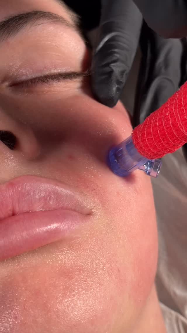 And also.. collagen production 🙌🏽
From the age of just under 30 our collagen production starts to deplete yearly, leaving us with less plump skin. The boost you need? Microneedling 🎉