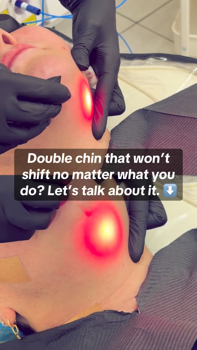 The chin area is one of the hardest places to tone — it’s where fat cells love to hold on, even when you’re eating clean and moving daily.
EndoFuze targets that exact layer, melting the fat and tightening the skin from underneath — no harsh suction, no downtime, just science that actually works.
Using dual laser wavelengths, we melt stubborn submental fat while stimulating collagen to lift and tighten loose skin — perfect for clients who feel like they’ve ‘tried everything’.
🎄 We’re offering 50% OFF EndoFuze in the run-up to Christmas
💫 Book at least 2 weeks before events to allow full healing and skin tightening
💋 Link’s in bio — spaces are going fast, angel.
#aestheticsderby #lipfillerderby #lipfiller #aestheticsnottingham #aestheticsleicester #russianlips #aestheticsbirmingham #aesthetics #endolaser #endoláser #endolift #endolifting