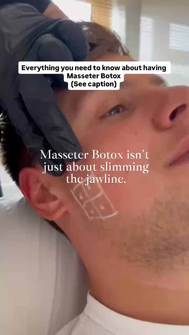 ✨ Everything You Need to Know About Masseter Botox ✨
Masseter Botox is one of those treatments that delivers both cosmetic and medical benefits — a true favourite for many of my clients.
💫 Cosmetic Benefits
Masseter Botox can soften the lower face, reduce facial width, and create a slimmer, more contoured jawline. Perfect if you’re looking for a gentle, natural facial refinement.
💆♀️ Medical Benefits
It’s also incredibly effective for jaw tension, teeth grinding (bruxism), headaches related to clenching, and overall muscle discomfort in the jaw area. Relief + aesthetics = a win-win.
⏳ How Long It Lasts
Results typically last 3–6 months, depending on muscle strength and individual response.
✨ Key Things to Know
You may need two sessions initially to fully weaken the muscle — especially if the masseter is strong. Over time, as the muscle reduces in size and activity, maintenance becomes less frequent, and many clients notice longer-lasting relief and contouring.
A powerful, multi-benefit treatment that transforms both comfort and confidence
𝖡𝗈𝗈𝗄𝗂𝗇𝗀𝗌
☏ 𝟢𝟩𝟦𝟫𝟪𝟫𝟪𝟩𝟣𝟪𝟪
☞︎ 𝗆𝗂𝖽𝗅𝖺𝗇𝖽𝖼𝗅𝗂𝗇𝗂𝖼𝗌@𝗀𝗆𝖺𝗂𝗅.𝖼𝗈𝗆
✩ 𝗐𝗐𝗐.𝗆𝗂𝖽𝗅𝖺𝗇𝖽𝖼𝗅𝗂𝗇𝗂𝖼.𝖼𝗈.𝗎𝗄
𝖬𝗂𝖽𝗅𝖺𝗇𝖽 𝖠𝖾𝗌𝗍𝗁𝖾𝗍𝗂𝖼𝗌 𝖢𝗅𝗂𝗇𝗂𝖼 𝖢𝗈𝗏𝖾𝗇𝗍𝗍𝗒
✩ 𝖬𝖾𝖽𝗂𝖼𝖺𝗅 𝖯𝗋𝖺𝖼𝗍𝗂𝗍𝗂𝗈𝗇𝖾𝗋 𝖫𝖾𝖽 𝖠𝖾𝗌𝗍𝗁𝖾𝗍𝗂𝖼𝗌
✩ 𝖥𝗎𝗅𝗅𝗒 𝖨𝗇𝗌𝗎𝗋𝖾𝖽 𝖢𝗈𝗌𝗆𝖾𝗍𝗂𝖼 𝖢𝗅𝗂𝗇𝗂𝖼
✩ 𝖯𝗋𝗂𝗏𝖺𝗍𝖾 𝖺𝗇𝖽 𝖢𝗈𝗇𝖿𝗂𝖽𝖾𝗇𝗍𝗂𝖺𝗅
#MasseterBotox #JawlineSlimming #BruxismRelief #TeethGrinding #JawTension #FacialAesthetics #NonSurgicalTreatments #BotoxTreatment #LowerFaceSlimming #AestheticClinic #CosmeticInjectables #JawPainRelief #FaceContouring #BotoxResults #SkinConfidence #BeautyTreatments #MedicalAesthetics #ClenchingRelief #BruxismTreatment #MasseterReduction