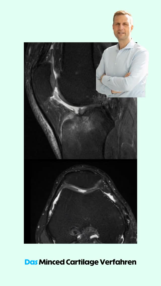 Minced Cartilage (Autocart) zur Behandlung von Knorpelschäden ##knee #science #kneesurgery #arthroscopy #mensicus #acl #cruciate #kneeinjury #injury #osteoarthritis #cartilage #cartilagerepair #meniscustear #joint #kneepain #jointpreservation #arthroscopy #kneearthroscopy #profniemeyer