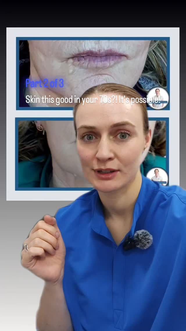 Skin first, always!
These are my fave cases 🫶
Just look at these results!
Skinpen Microneedling ✅
Profhilo ✅
Muscle relaxation ✅(of the chin)
Not a formal filler in sight for this case.
Approx 9 months between photos, which really isn't that long when you think of the decades of skin damage we were working against 💙
Part 3 will be up soon
Megan x
Dentist led aesthetics & skincare in Glasgow
#skinpen #profhilo
