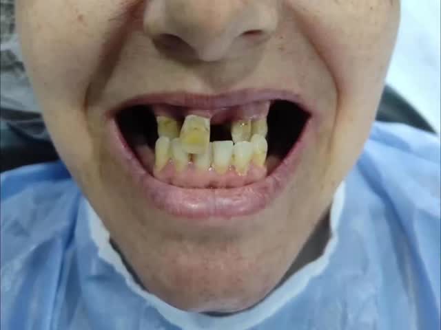 Dentes Fixos no dia - Veja como o Dr. Helder Lopes transformou este sorriso.
O Poder da Estética e Fun