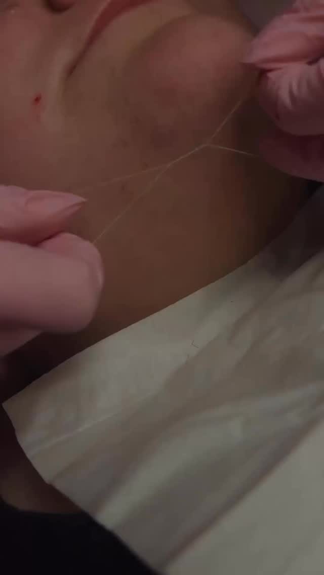 PCOS can cause unwanted facial hair, and it’s way more common than people think. Wendy specializes in threading for sensitive skin + hormonal hair growth, and she creates such a safe, judgment-free space. You deserve to feel confident — let us help!💕
Dm us, book on our website, or call the salon to book now!
#pcos #pcosawareness #pcossupport #unwantedhair #facialhairremoval