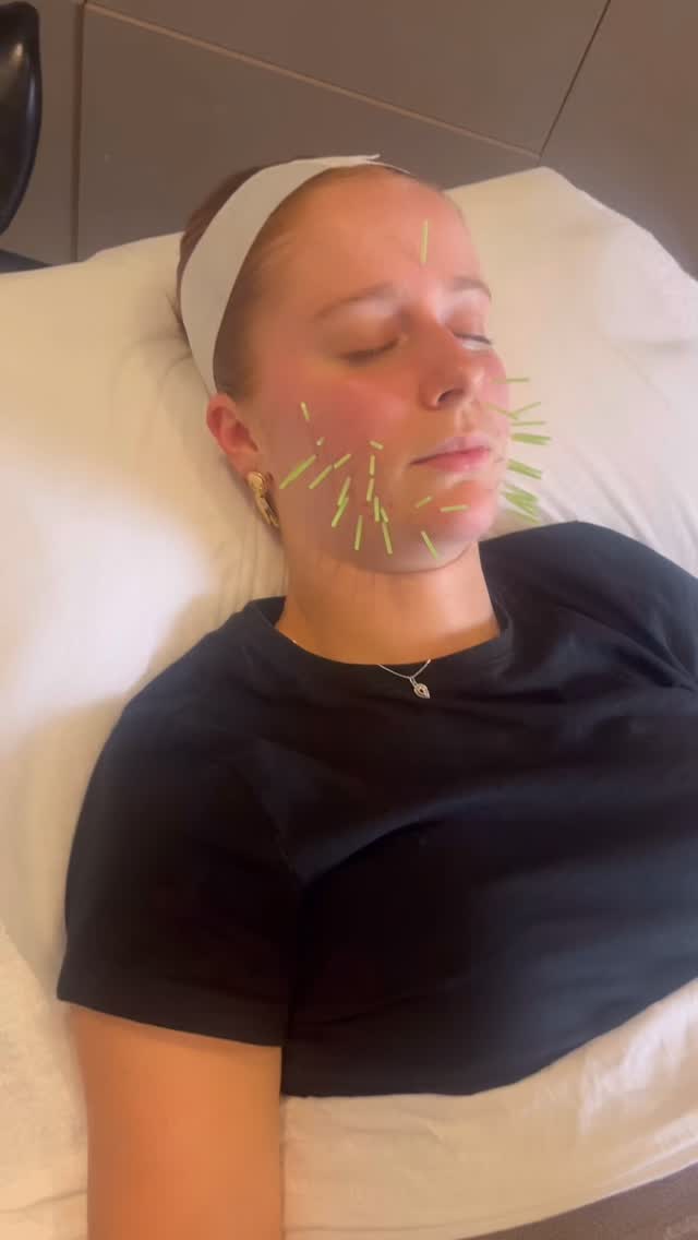 Your skin is a messenger
👉 Your skin is your body’s last eliminatory organ
👉 Your skin’s microbiome is connected to your gut’s microbiome
👉 Your skin feels your stress
👉 Your skin is intimately connected with your cycle
👉 Your skin is made up of mineral and fats.. you need these in the diet to nourish your skin
‼️Your skin is a living, breathing organ that expresses imbalances within the greater living, breathing organism (You).
Start listening to your body instead of suppressing symptoms 🫶
DM me Clear Skin to learn more about my holistic approach to balancing your skin for the long run 🙌
#skinnaturopath #naturopathy #skinhealth #acnetips #acnesupport #acupuncture #holisticskin #skingutconnection #skinglow #skinmicrobiome #biomicroneedling #cosmeticacupuncture #clearskin #clearskinjourney