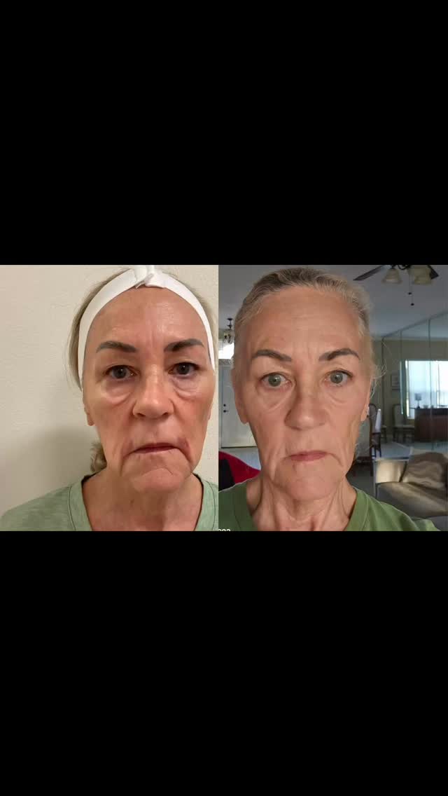 2-Month Update After HIFU Treatment.‼️‼️‼️
Collagen and elastin are still actively developing.
These procedures work gradually, so patience is essential - but the results are often worth the wait..
#capricebeautybar #age #theskingames2024 #sarasotaflorida #sarasota #hifu #sarasotaskincare #sarasotahifu #sarasotalaser #sarasotafacialspecialist #sarasotamedspa #sarasotawoman #siberianbeautyskin
Capricebeautybar.com
#201-961-5571‼️‼️