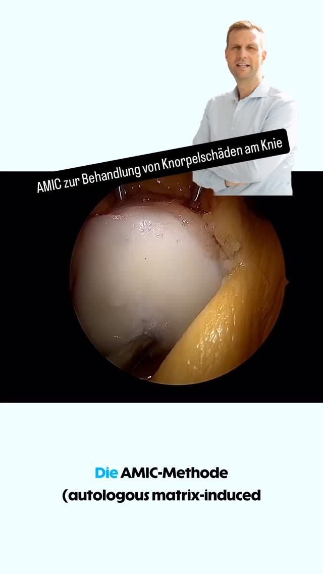 AMIC zur Behandlung von Knorpelschäden ##knie #knieverletzung #knieschmerzen #arthroskopie #kreuzband #knieexperte #gelenke #operation #orthopaedie #knieoperation #profniemeyer #reha #rehabilitation #physio #arthrose #gonarthrose #meniskus #meniskusriss