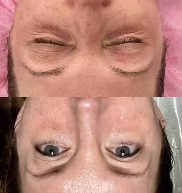 Love results just after 10 days ..‼️‼️
#capricebeautybar #age #sarasotaflorida #sarasota #medspa #hifu #co2 #sarasotawomanownedbusiness #sarasotaspas #siestakeywoman #venisflorida #lakewoodranchflorida
http://capricebeautybar.com/