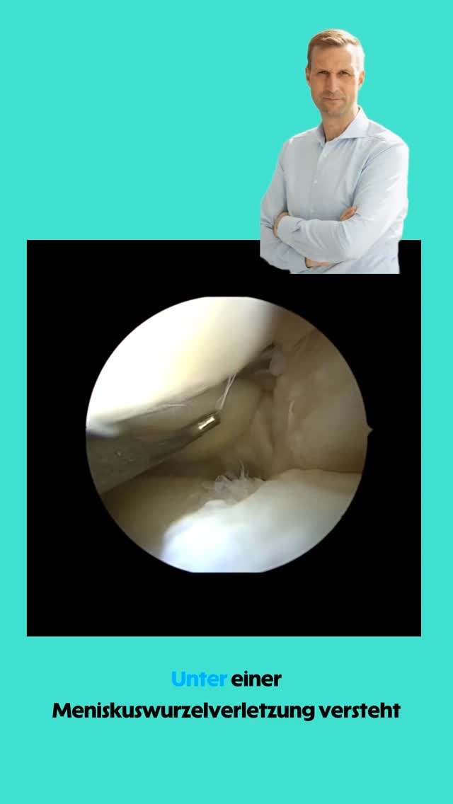 Meniskuswurzelverletzung ##knie #knieverletzung #knieschmerzen #arthroskopie #kreuzband #knieexperte #gelenke #operation #orthopaedie #knieoperation #profniemeyer #reha #rehabilitation #physio #arthrose #gonarthrose #meniskus #meniskusriss