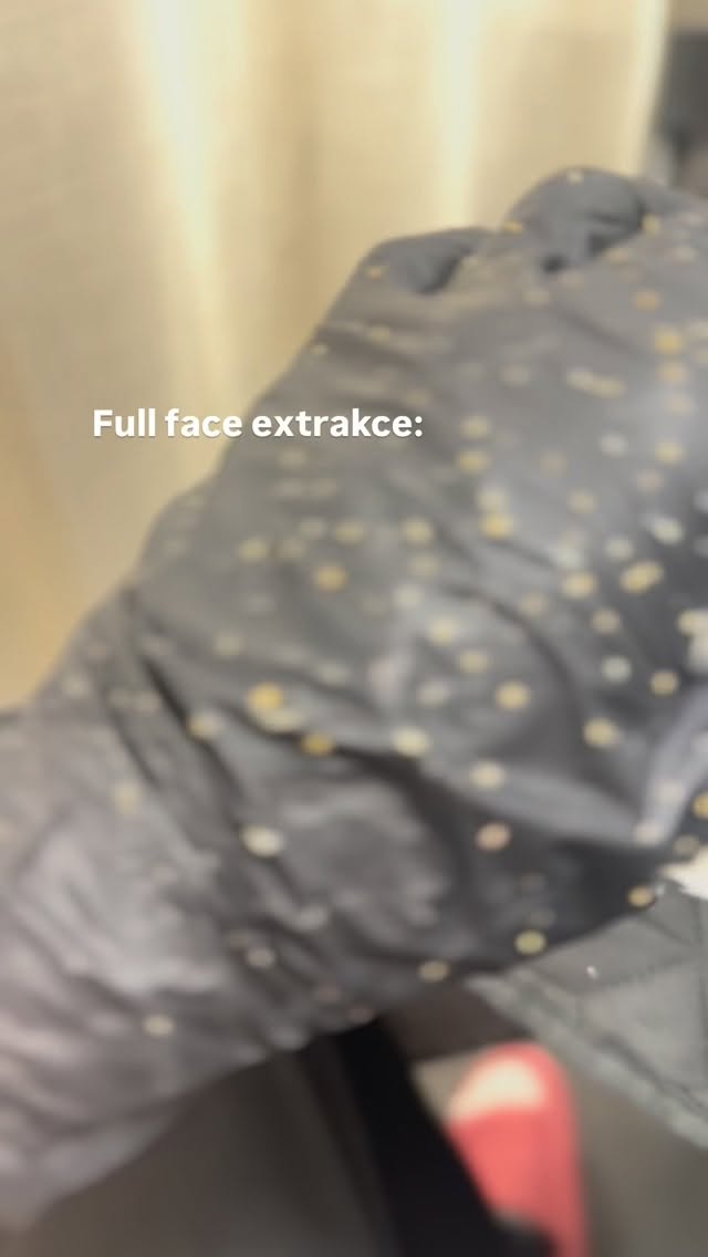 Na první pohled super sjednocený obličej bez jakéhokoliv zánětu a začervenání?
Na druhý pohled je to trošku jinak…
#peceoplet #akne #extrakceporu #komedony #aknozniplet #kosmetickapece