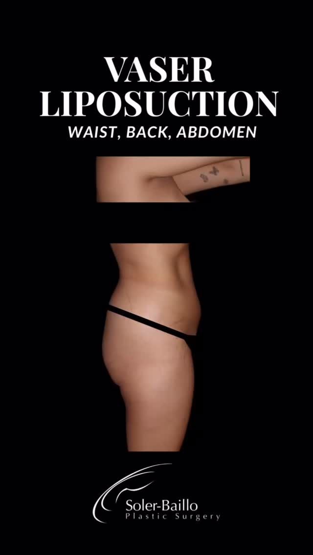🔥 Full 360° Reshaping.
By combining VASER Liposuction of the waist, back, and abdomen with strategic Trochanter Fat Grafting, Dr. Soler-Baillo created balance, symmetry, and beautiful curves for this stunning patient.
✨ Ready for your transformation?
📩 DM us to schedule your consultation
📞 305-661-1996
📍 Coral Gables, FL
#liposuction #liposuctionbeforeandafter #vaserliposuction #lipo360 #plasticsurgerymiami